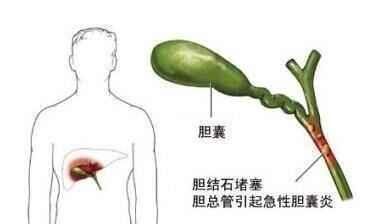 胆结石多大建议手术治疗，胆结石多大建议手术1.3豪米-第1张图片-