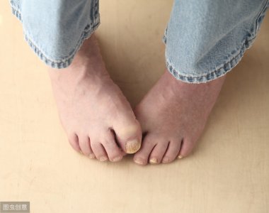 ​灰指甲用什么药 医生总结：灰指甲的5种药物治疗