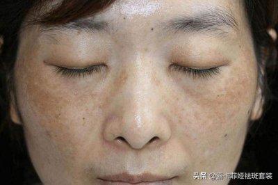 ​哪些祛斑产品比较好（哪种产品祛斑效果比较好？中国祛斑十大名牌好用的产品）