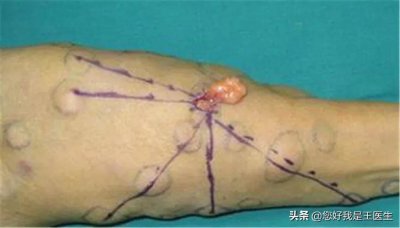 ​脂肪瘤如何消除？如何做到预防？
