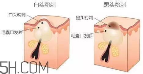 去黑头的最好方法 5分钟快速祛黑头