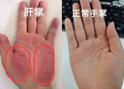 ​肝掌会自己消失吗？快去看看你的手掌，杨主任教你如何辨别