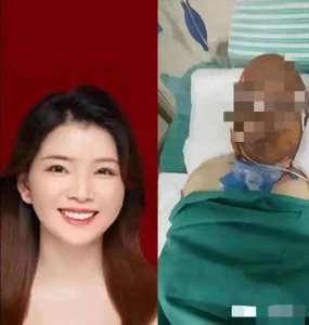 ​绝望中的坚强：烧伤妈妈的泪水与爱，丈夫剃光头的背后故事！