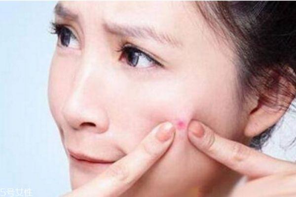 经常熬夜脸上长痘痘怎么办 熬夜起痘痘怎么调理 经常熬夜脸上长痘痘怎么办 熬夜起痘痘怎么调理