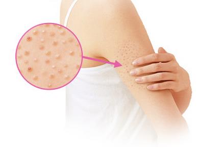 好用且去鸡皮肤的身体乳推荐 有鸡皮肤要注意 好用且去鸡皮肤的身体乳推荐 有鸡皮肤要注意