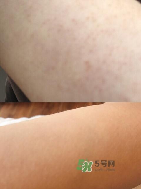 去鸡皮肤产品怎么选择 去鸡皮肤产品使用步骤 去鸡皮肤产品怎么选择 去鸡皮肤产品使用步骤