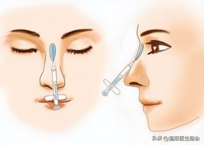​鼻梁注射玻尿酸 “玻尿酸隆鼻”是大热项目，简单快速，为什么我不建议大家做？