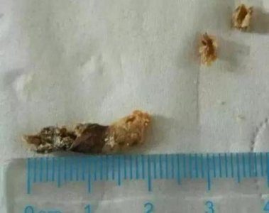 ​耳朵耳屎太深了怎么取出来(耳屎太深了怎么办)