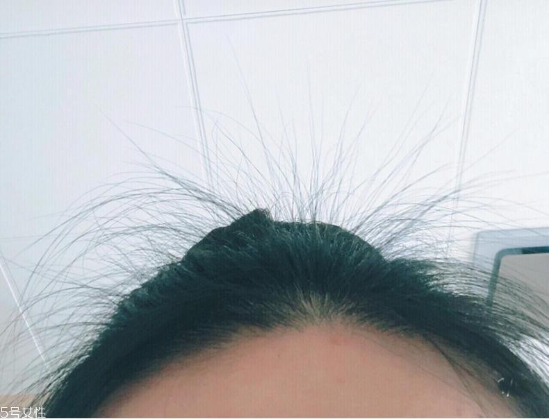 霸王育发液能生发吗 霸王育发液用了头痒怎么回事 霸王育发液能生发吗 霸王育发液用了头痒怎么回事