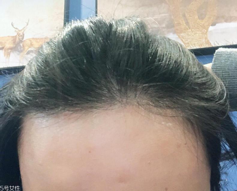 霸王育发液能生发吗 霸王育发液用了头痒怎么回事 霸王育发液能生发吗 霸王育发液用了头痒怎么回事