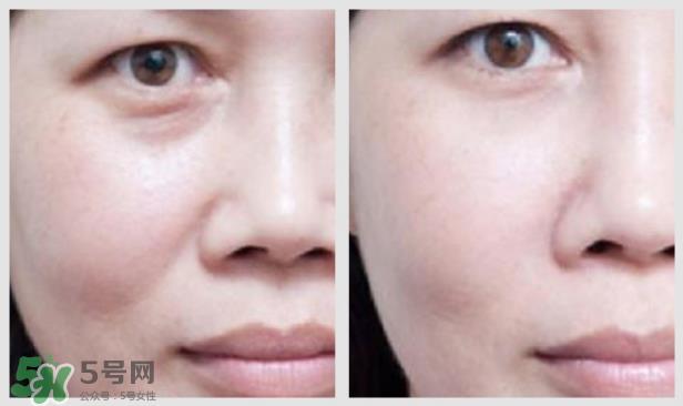 法令纹怎么消除?如何正确对待法令纹? 法令纹怎么消除?如何正确对待法令纹?