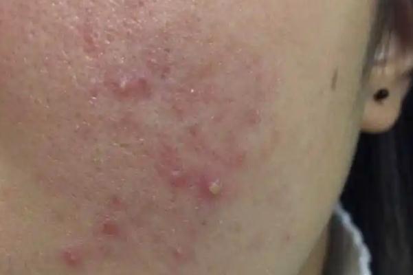 毛孔粗大会自己好吗 毛孔粗大会导致什么后果 毛孔粗大会自己好吗 毛孔粗大会导致什么后果