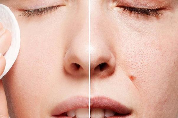 毛孔粗大会自己好吗 毛孔粗大会导致什么后果 毛孔粗大会自己好吗 毛孔粗大会导致什么后果