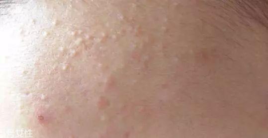 刷酸时要注意什么 刷酸去闭口操作指南 刷酸时要注意什么 刷酸去闭口操作指南