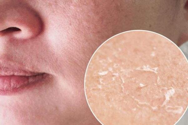 皮肤干燥脱皮严重像鱼鳞怎么办 皮肤干燥起皮像鱼鳞是怎么回事 皮肤干燥脱皮严重像鱼鳞怎么办 皮肤干燥起皮像鱼鳞是怎么回事